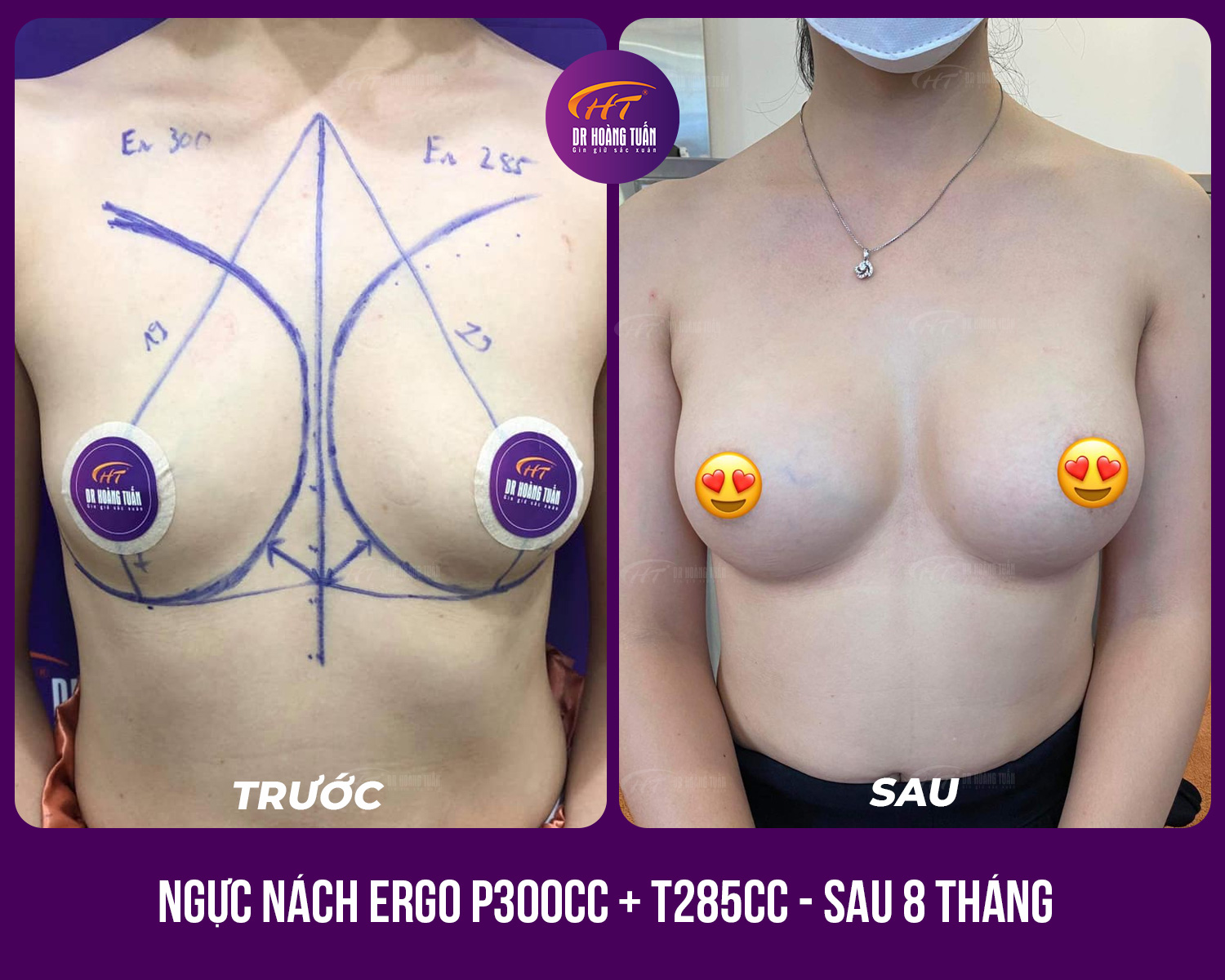 Kết quả nâng ngực đường nách - Dr Hoàng Tuấn